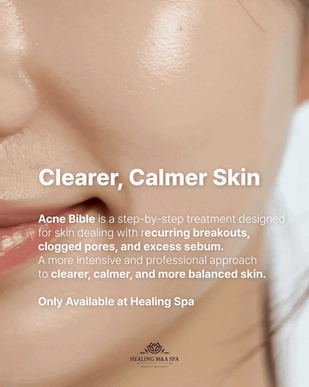Acne skin treatment
